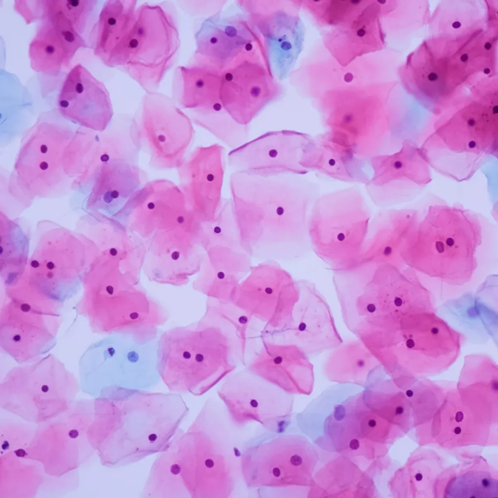 Cervical Cancer: Northern Ireland Urged to Adopt HPV Testing