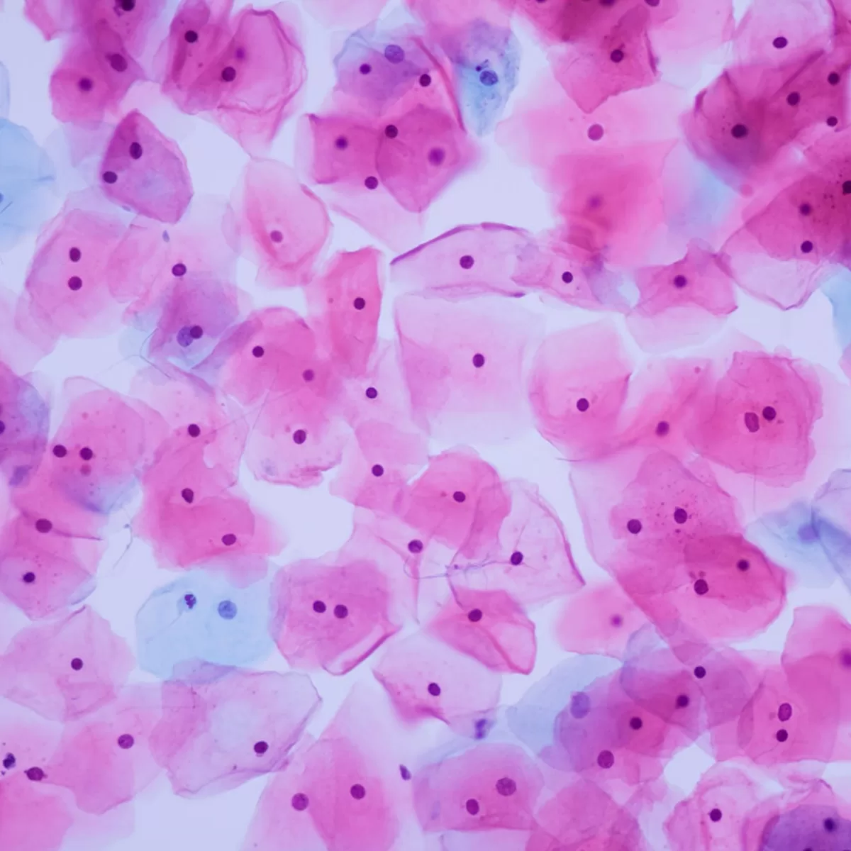 Cervical Cancer: Northern Ireland Urged to Adopt HPV Testing