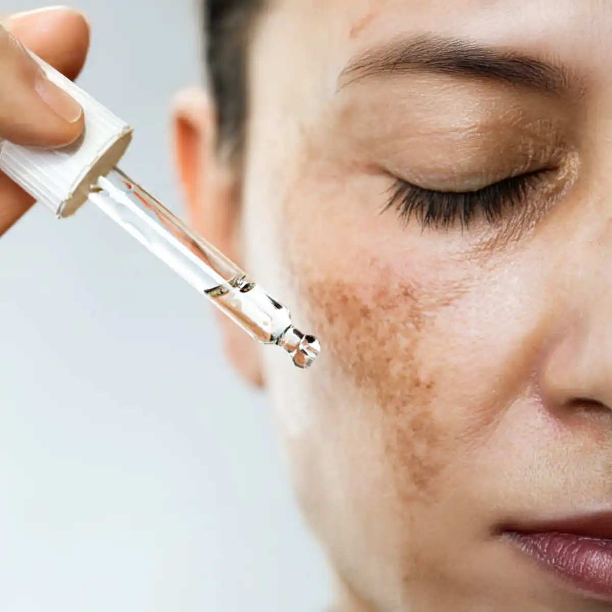 Calciphylaxis